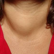 thyroid-tumour